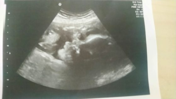 妊娠28週　エコー写真　ブログ